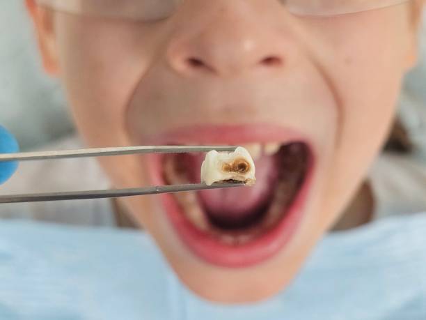 Best Emergency Root Canal Treatment in Morganville, NJ